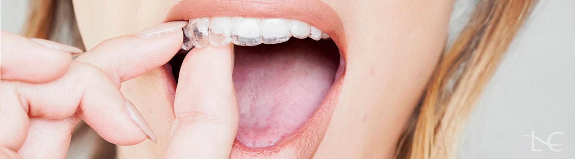 Invisalign: quanto custa o tratamento e como funciona? - Ortodontia Curitiba